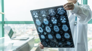 brain disease