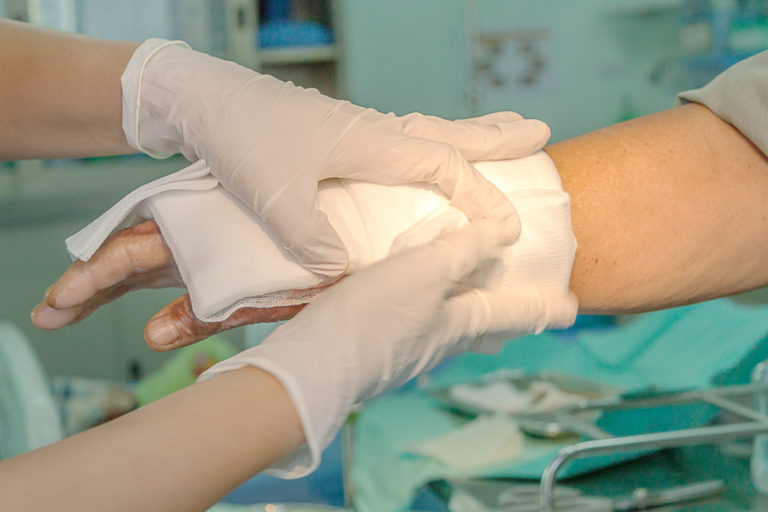How to Prevent Scars After a Burn Injury